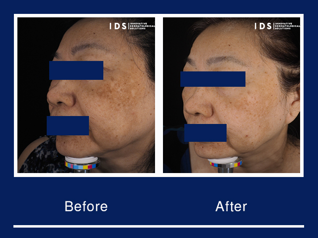 Before and after result for IDS Brightening Program
