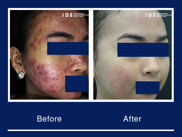 Before and after result for IDS Acne Program